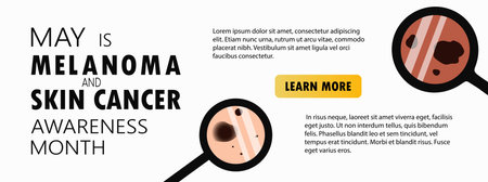 Melanoma and skin cancer awareness month landing page template. Banner template with moles, birthmarks under magnifying glass and copy space for text. Vector illustrationのイラスト素材