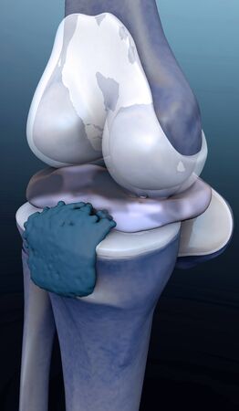 human joint destruction, 3d rendered knee illustration, pain illustration knee side, 3d illustration knee side,の写真素材