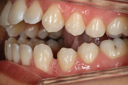 A close-up image of an adults mouth showing a missing tooth in the front.