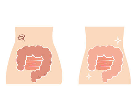 A set of moderately unhealthy intestines and moderately healthy intestines.のイラスト素材