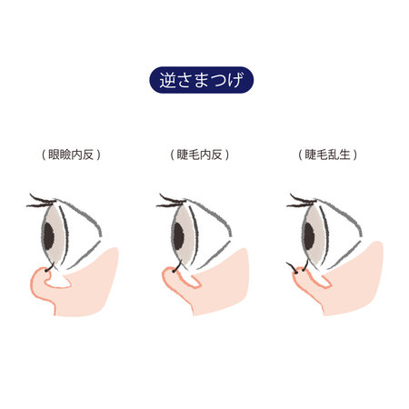 3 types of ingrowing eyelashes (entropion, entropium ciliarum, and trichiasis).
"GANKEINAIHAN" means entropion, "SHOMONAIHAN" means entropium ciliarum, "SHOMORANSEI" means trichiasis.のイラスト素材