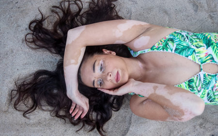 Beautiful brunette mature woman with vitiligo pigment spot disease and long black hair lies...