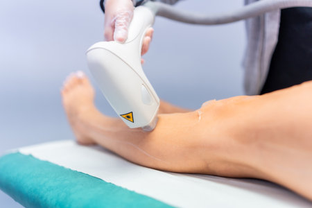 Beautician using laser machine on legs of a woman to remove hairの写真素材
