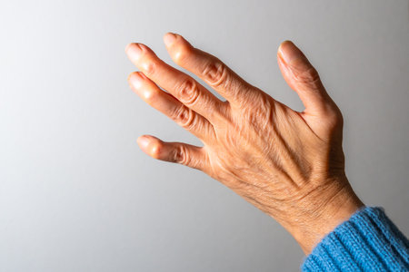Close up of a senior woman's hand, revealing swollen joints and deformities caused by arthritisの写真素材