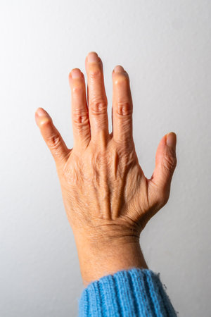 Senior woman showing her hand with osteoarthritis symptoms, highlighting joint inflammation and finger deformationの写真素材