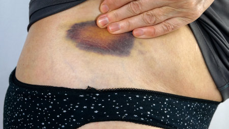 Hands of senior woman examines purple big bruise or haematoma and touches with fingers. Subcutaneous trauma from domestic violence or injury. Close-up.の写真素材