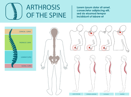 Arthrosis of Spine. Cervical, Thoracic and Lumbar Curves. Icon with Spine Problem. Illustrations of traumatology and orthopedics. Skeleton Spine. Vector Illustration.のイラスト素材