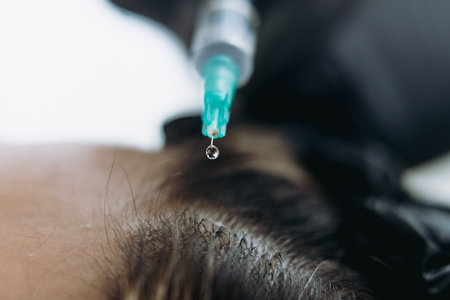 close up on woman head getting mesotherapy injections for stronger and healthier hair. High quality...
