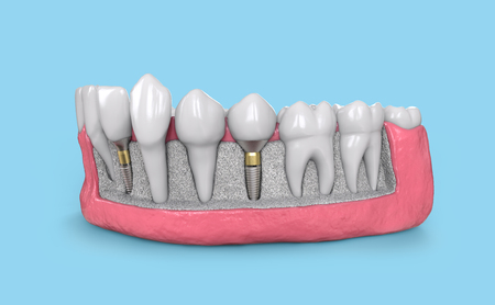 tooth implant model in jaw 3d illustrationの写真素材