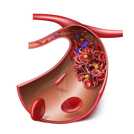 Blood clot and thrombosis. Medical illustration. 3d vectorのイラスト素材