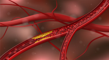 Artery blocked by cholesterol. Vector illustration