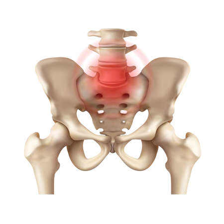 Ankylosing spondylitis at the junction of the sacrum and spine. Vector illustrationのイラスト素材