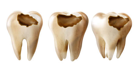 Dental model of a tooth, illustration as a concept of dental examination of teeth, dental health and hygiene.のイラスト素材