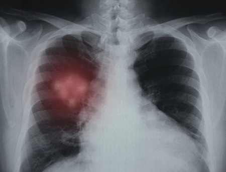 Lung Cancer. X-ray image of patient lungs to lung disease.の写真素材