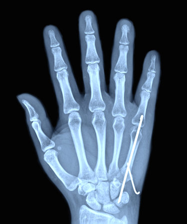 hand and finger x-ray images of patient to broken and Iron welt.