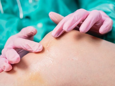 Close-up of a doctors hand in medical gloves, rubbing cream to heal an injured knee joint. Bruise under the knee. Knee ligament injury.の写真素材