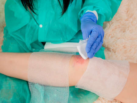 The doctors hands in blue gloves treat the wound on the girls knee with antiseptic.の写真素材