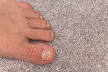 Nail diseases on left mans leg on grey carpet, view from the top, copy space.の写真素材