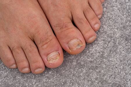 Close up of caucasian male damaged toe on man feet on gray carpet, copy space, cosmetology concept, podology problemの写真素材