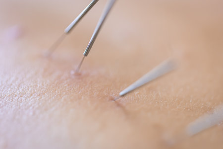 Dry needling acupuncture needles on patient, close up.の写真素材