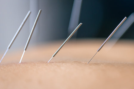 Dry needling acupuncture needles on patient, close up.の写真素材