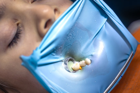 The dentist treats the childs tooth using a rubber dam. Close-up of tooth treatment.の写真素材