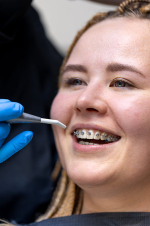 Dental procedure for installing braces close up. Dentistry. Braces on the teeth.