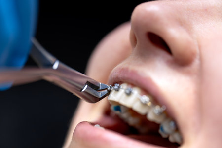 Dental procedure for installing braces close up. Dentistry. Braces on the teeth.の写真素材