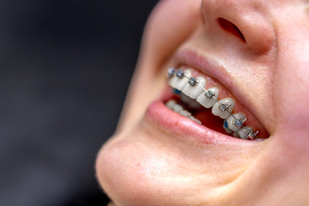 Dental procedure for installing braces close up. Dentistry. Braces on the teeth.の写真素材