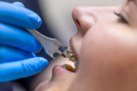 Dental procedure for installing braces close up. Dentistry. Braces on the teeth.の写真素材