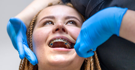 Dental procedure for installing braces close up. Dentistry. Braces on the teeth.の写真素材