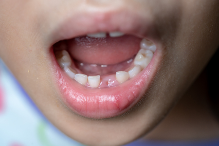Young girl lost her first bottom front milk teeth. Childhood healthcare concept.の写真素材