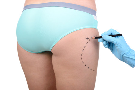 Marking body before surgery. Close-up of female body and hand in glove marking with felt tip pen