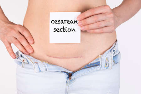 Woman belly with scar and caesarean section text on white sticker. Five months after surgery.