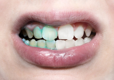 Baby mouthwash. Dental plaque. Teeth. Teeth before and after brushing and whitening in one photo. Dental hygieneの写真素材