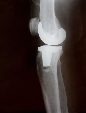 Total knee replacement x-ray side pictureの写真素材