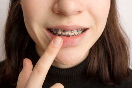 Orthodontic treatment. Dental care concept. Smiling teenage girl with braces. Metal braces close-up on the teeth.の写真素材
