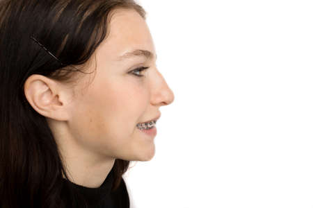 Orthodontic treatment. Dental care concept. Smiling teenage girl with braces. Metal braces close-up on the teeth.の写真素材