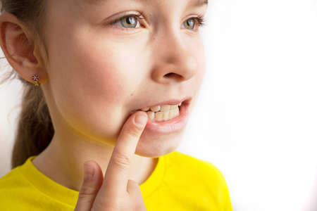 Little girl stands on a white background with a beautiful smile, children crooked teeth, pediatric dentistry. Crooked teeth close-up. Correction of malocclusion is required.の写真素材