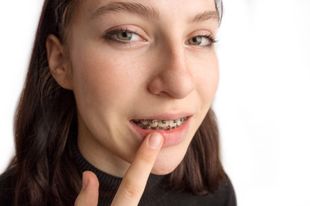 Orthodontic treatment. Dental care concept. Smiling teenage girl with braces. Metal braces close-up on the teeth.の写真素材