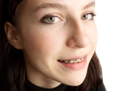 Orthodontic treatment. Dental care concept. Smiling teenage girl with braces. Metal braces close-up on the teeth.の写真素材