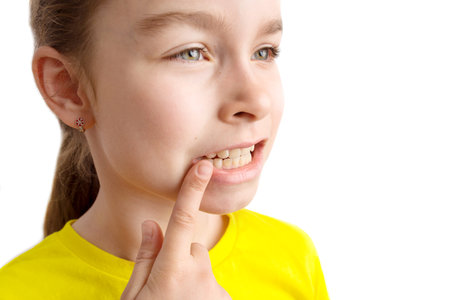 Little girl stands on a white background with a beautiful smile, children crooked teeth, pediatric dentistry. Crooked teeth close-up. Correction of malocclusion is required.の写真素材