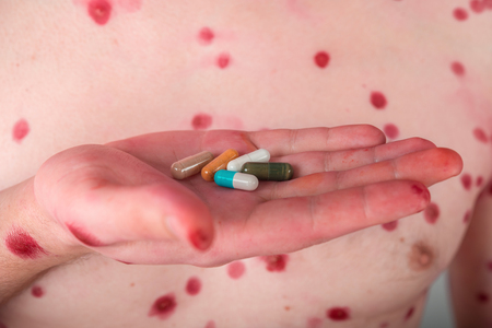 A man holding a pill in the palm of chickenpoxの写真素材