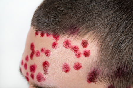 closeup a man forehead who having varicella blister or chickenpoxの写真素材