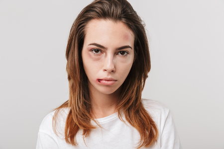 Portrait of a disabled young girl with scratches and bruises on her face looking camera.の写真素材
