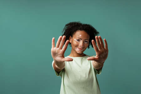 Young woman with vitiligo smiling while reaching her hands to camera isolated over blue wall