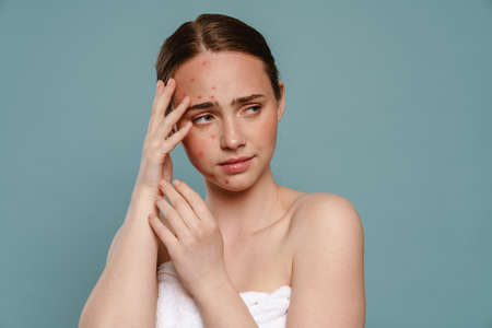 Ginger woman with pimples covering her face and looking aside isolated over blue backgroundの写真素材
