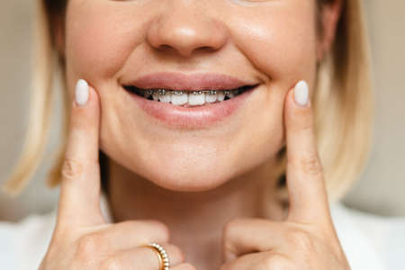 Young woman showing her brace while pointing fingers at her cheeks indoorsの写真素材
