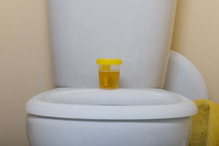 Urine in a container for analysis. Stands on the toilet seat. Disposable medical polymeric sterile...