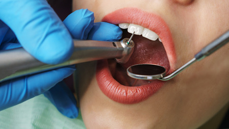 Dentist treats woman's teeth. Young girl with open mouth. White teeth. Dentist hands with medical instruments. Close-up. Dental clinic.の写真素材